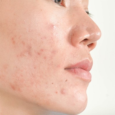 acné - condition cutanée
