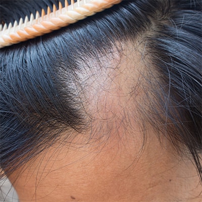traitement perte de cheveux - PRP